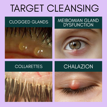 Load image into Gallery viewer, Eye health diagram showing clogged glands, meibomian gland dysfunction, collarettes, and chalazion with a purple background.