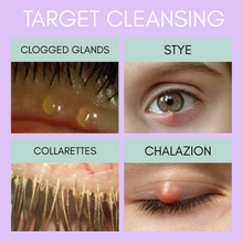 Load image into Gallery viewer, Educational diagram showing eye issues like clogged glands, sty, collarettes, and chalazion with corresponding images.