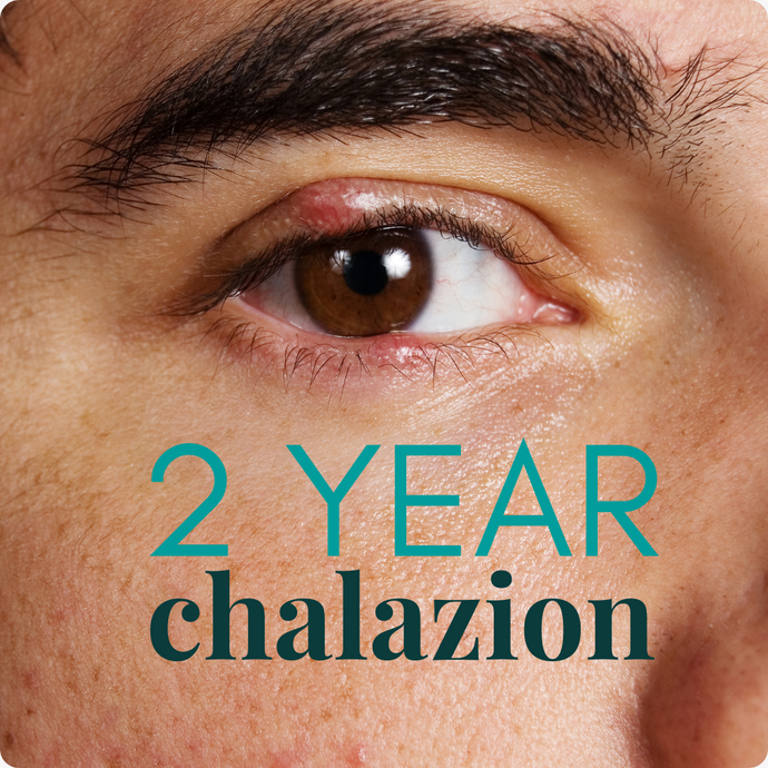 2 Year Old Chalazion Treatment: 3-Step Protocol with Focused Eye Roll