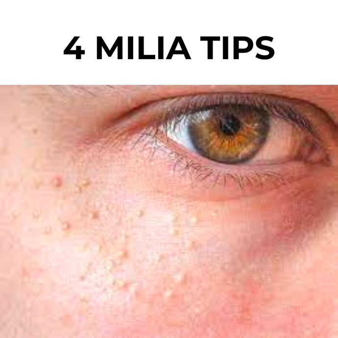 4 MILIA TIPS