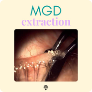 ACCUTANE meibomian gland dysfunction  MEIBOMIAN GLAND EXTRACTION frequency  ACCUTANE eyelid treatment schedule  MGD management on ACCUTANE