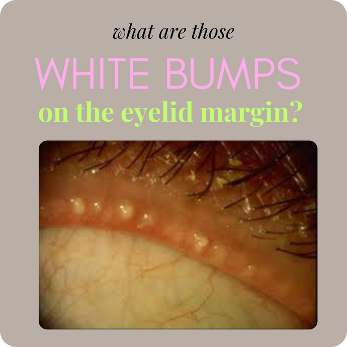 Little White Eyelid Bumps on The Eyelid Margin? How to Clear CLOGGED MEIBOMIAN OIL GLANDS Safely at Home