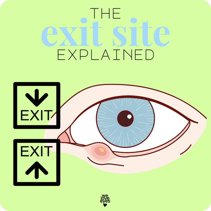 EXIT SITE Explained: Stye vs. Chalazion Drainage on the Eyelid Margin