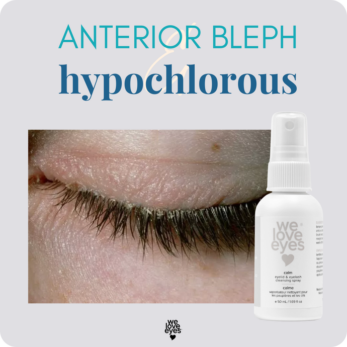Does Hypochlorous Acid Spray Help Treat Anterior Blepharitis? Optometrist Insight