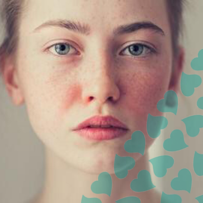 Let's Talk About Acne Rosacea