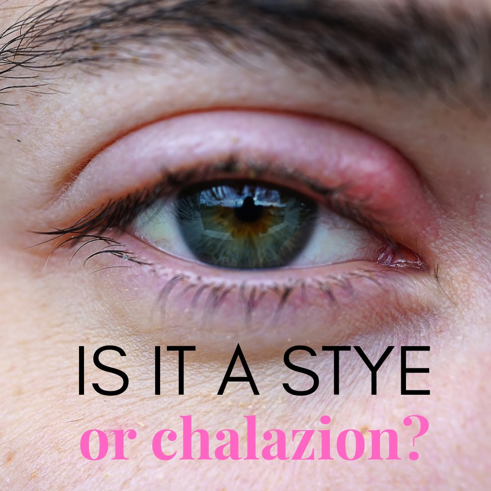 Stye vs. Chalazion: How to Identify and Treat Common Eyelid Bumps for ...