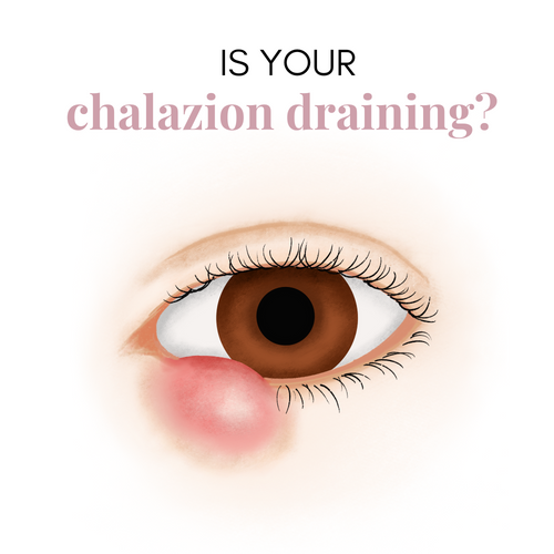 7 Key Indicators Your Chalazion Is Finally Draining: Optometrist Tips from Dr. Tanya Gill, OD