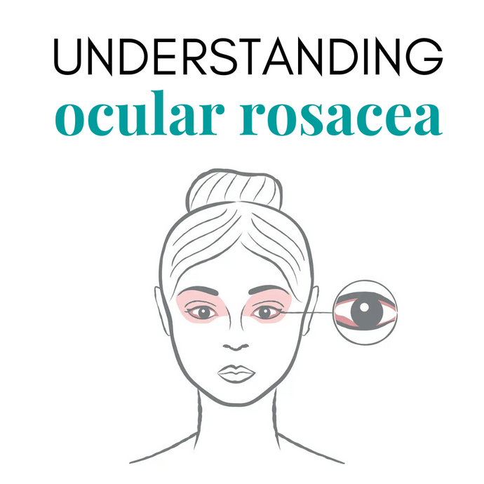 Ocular Rosacea: Top Causes, Best Treatments, and Why We Love Eyes Is Your Secret Weapon