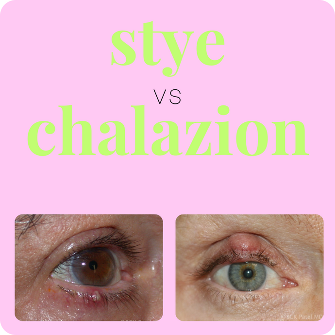 Breaking Down Stye versus Chalazion in Simple Terms